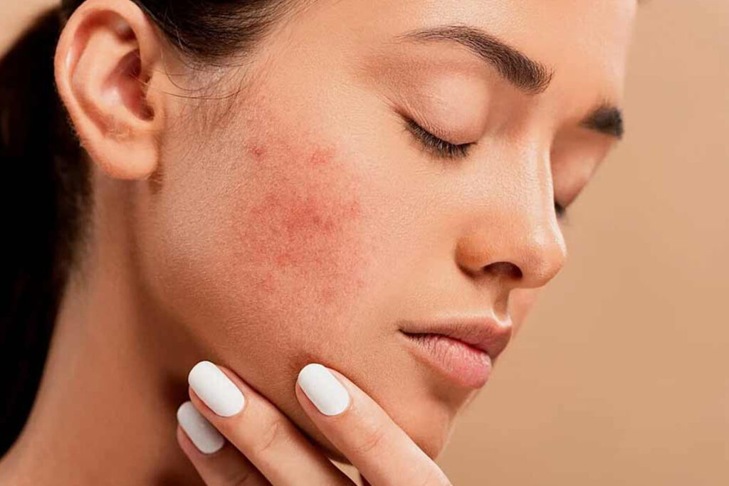 Acne Management Treatment